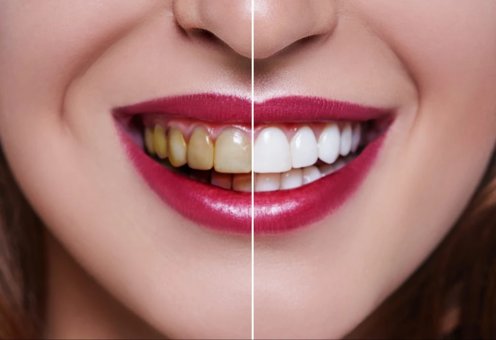 Arthur teeth whitening V1.0